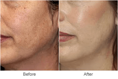 For best results with the CO2 laser for facial skin - Health