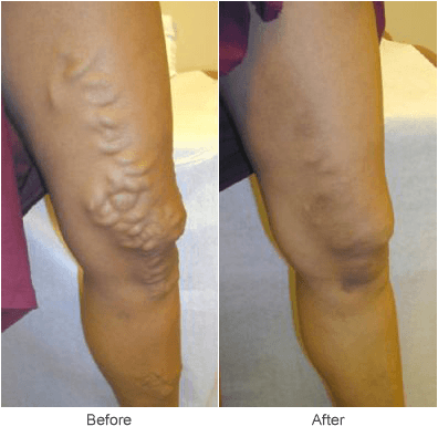 Treatment for Varicose Veins in St. Louis