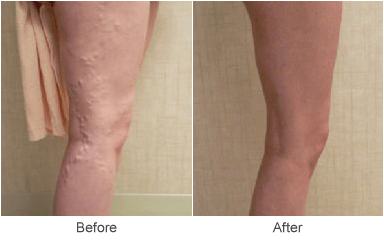 Treatment for Varicose Veins in St. Louis